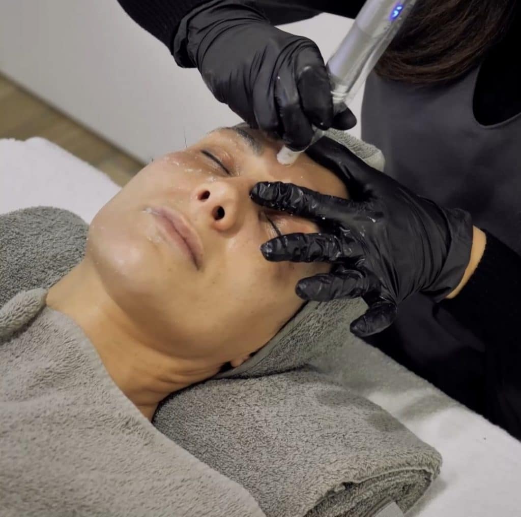woman face having a micropricking treatment
