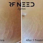 stretch marks before and after treatment