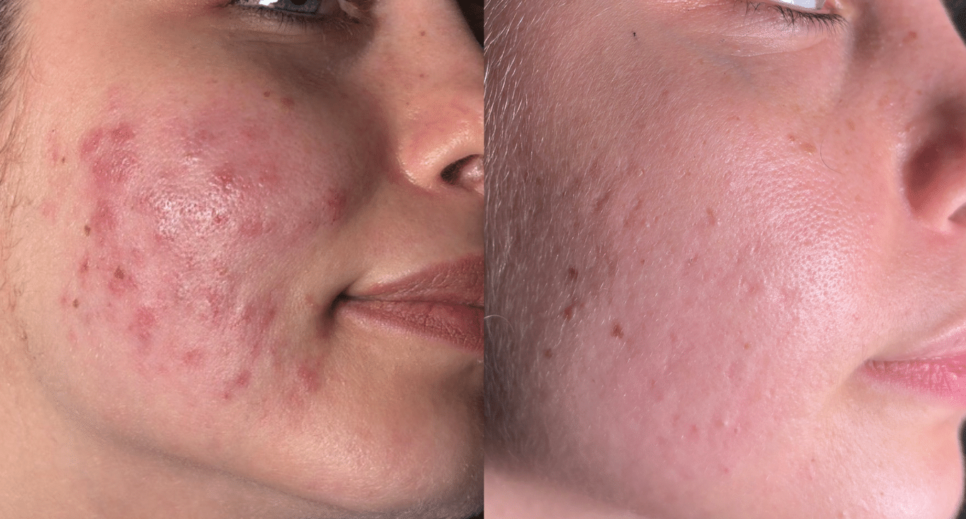before and after acne sara