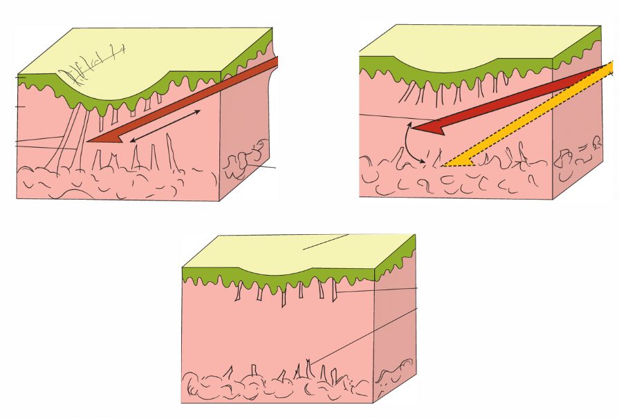Best Treatment for Acne Scars